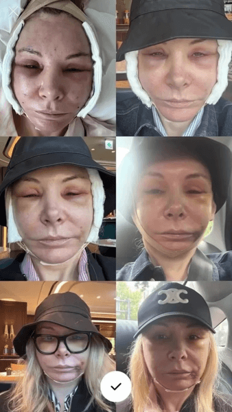 жінка зробила підтяжку Жінка зробила підтяжку обличчя в Сеулі